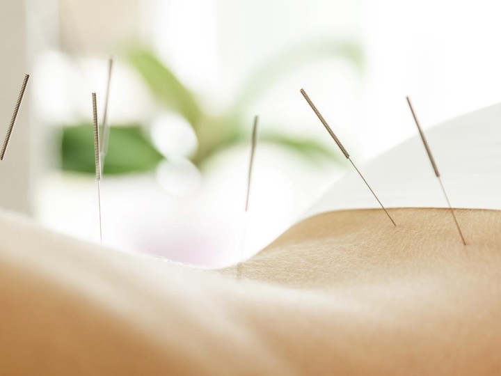 akupunktura lekiem na migrenę